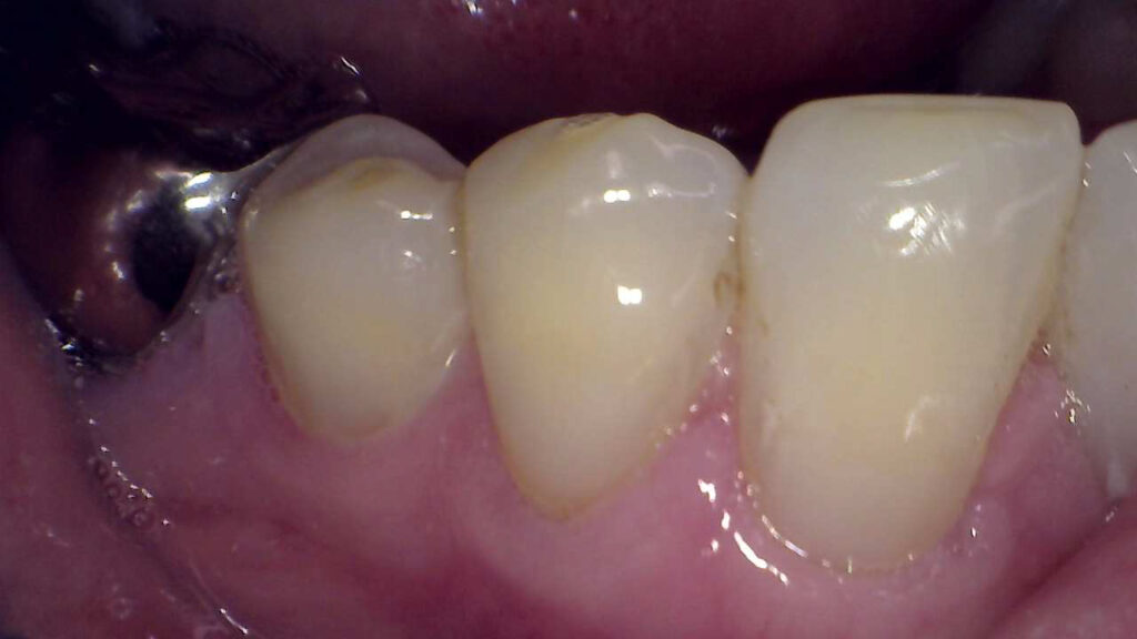 After Tissue Graft