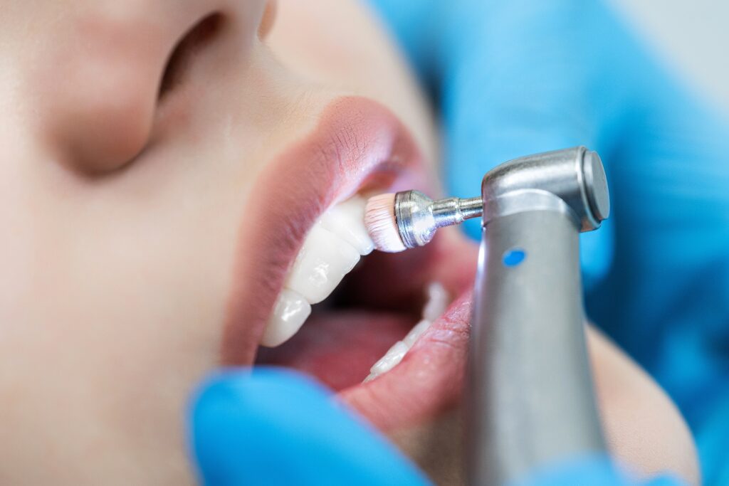 teeth whitening Collinsville